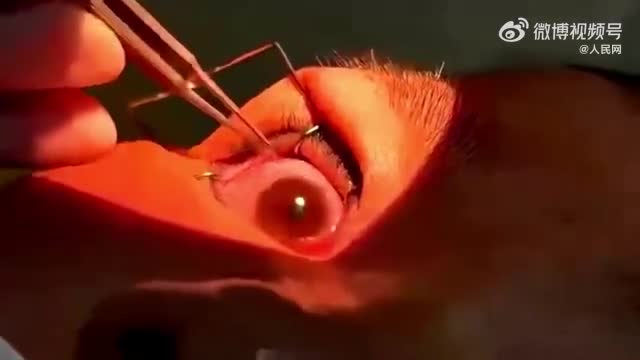 Video - Ngứa mắt đi khám, bác sĩ gắp ra thứ đáng sợ trong mắt người phụ nữ