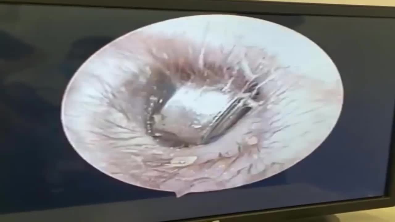 Video - Clip: Cận cảnh quá trình gắp cục pin ra khỏi tai bé trai 8 tuổi