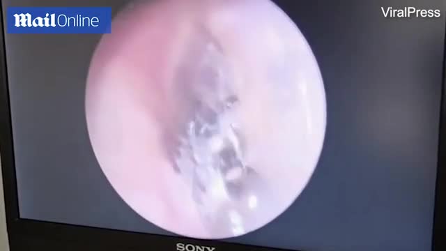 Video - Clip: Bác sĩ tá hỏa phát hiện 6 con nhện làm tổ trong tai người phụ nữ