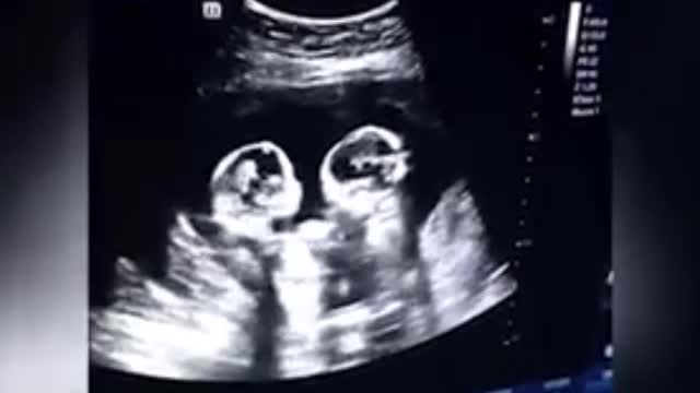 Video - Clip: Hai chị em sinh đôi 'ẩu đả' ngay từ trong bụng mẹ