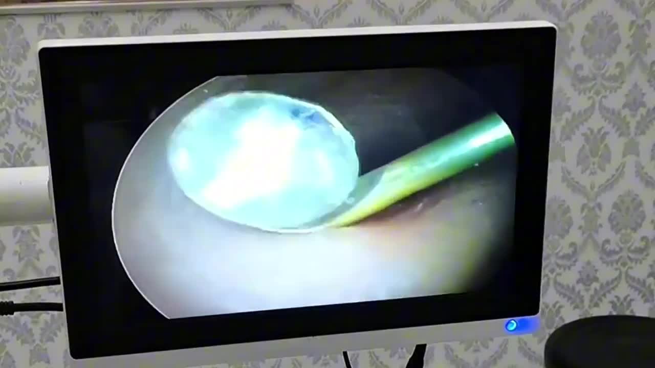 Video - Clip: Người phụ nữ bất ngờ phát hiện viên kim cương trong tai mình
