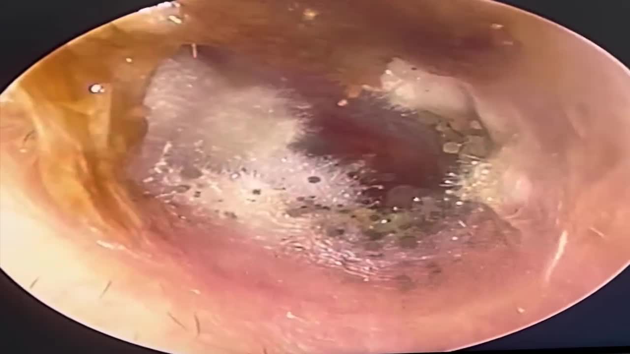Video - Đau tai đi khám, bác sĩ phát hiện thấy thứ mọc trong tai người phụ nữ