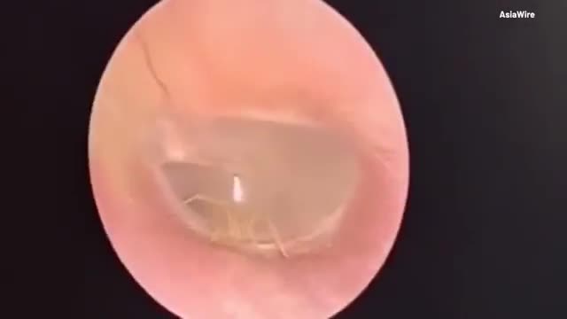 Video - Đau tai đi khám, bác sĩ phát hiện cảnh khó tin trong tai người phụ nữ