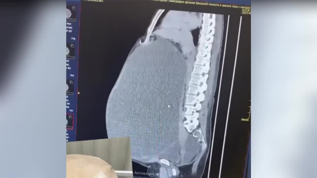 Video - Phát hiện người phụ nữ 61 tuổi có khối u buồng trứng nặng 30 kg