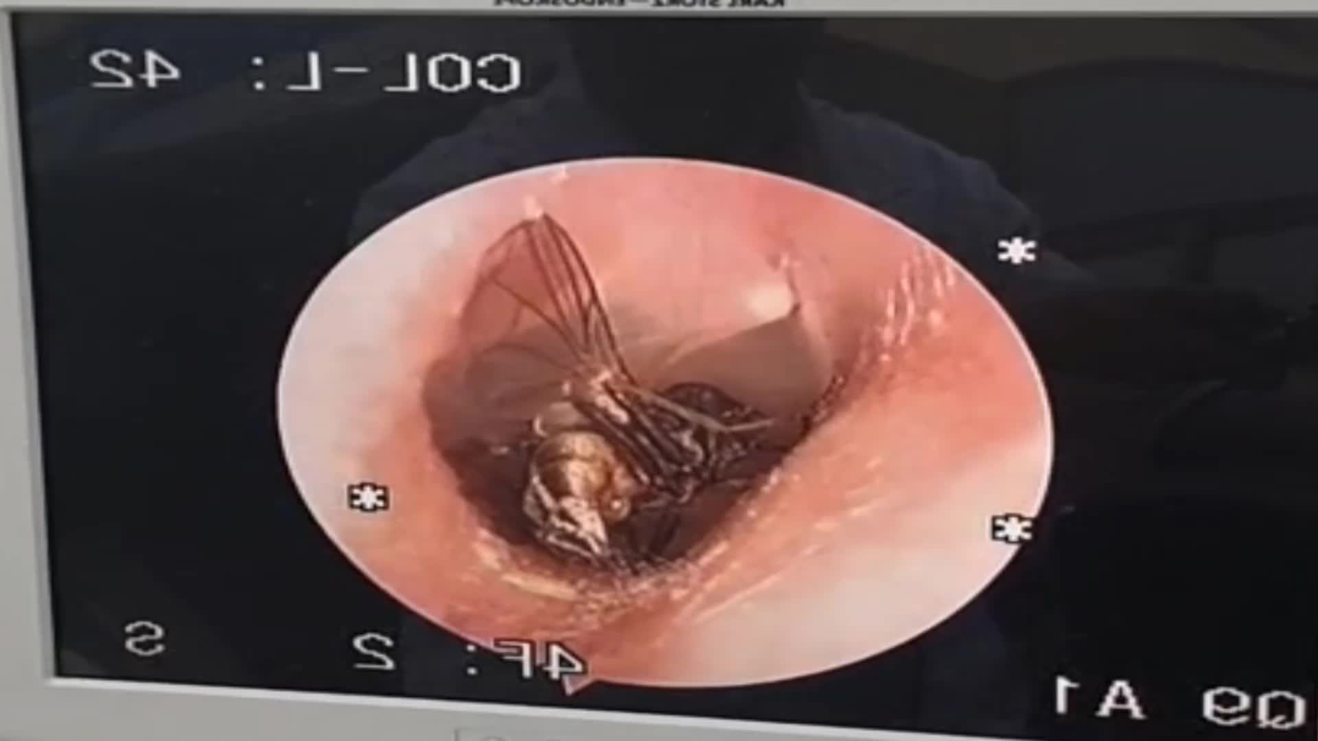 Video - Đau tai đi khám, bác sĩ phát hiện thứ bất ngờ trong tai người đàn ông