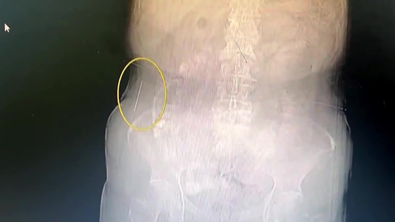 Video - Đau bụng đi khám, bác sĩ lấy ra thứ nguy hiểm trong bụng người phụ nữ