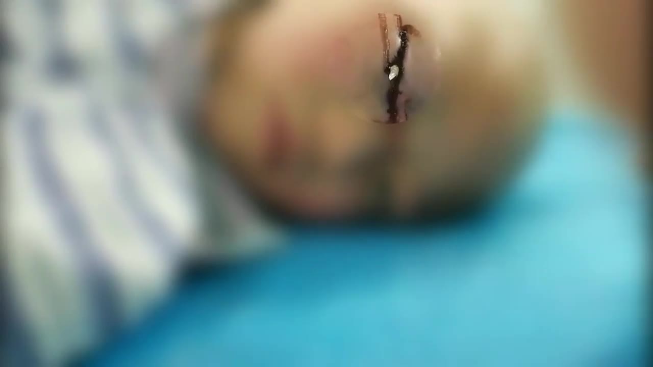 Bác sĩ Trung Quốc lạnh người lấy thanh thép ra khỏi mắt cậu bé