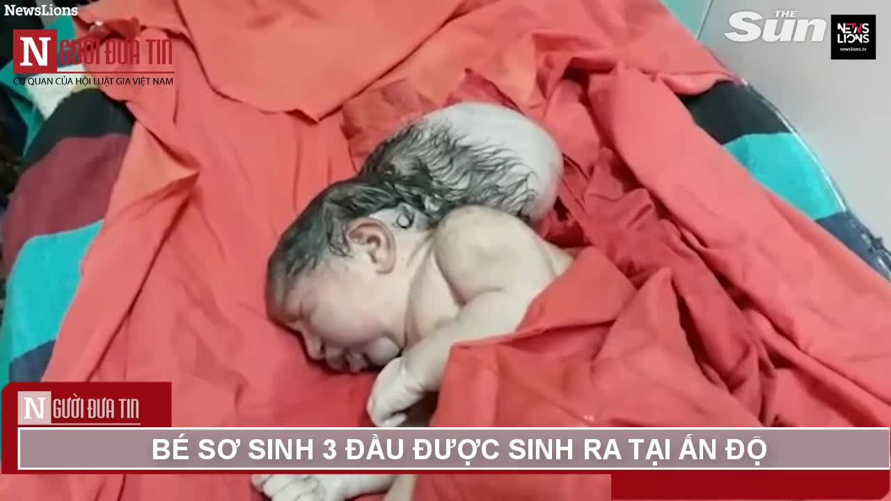 Bé sơ sinh “ba đầu” được sinh ra tại Ấn Độ
